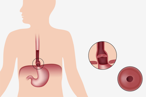 Hiatal_Hernia