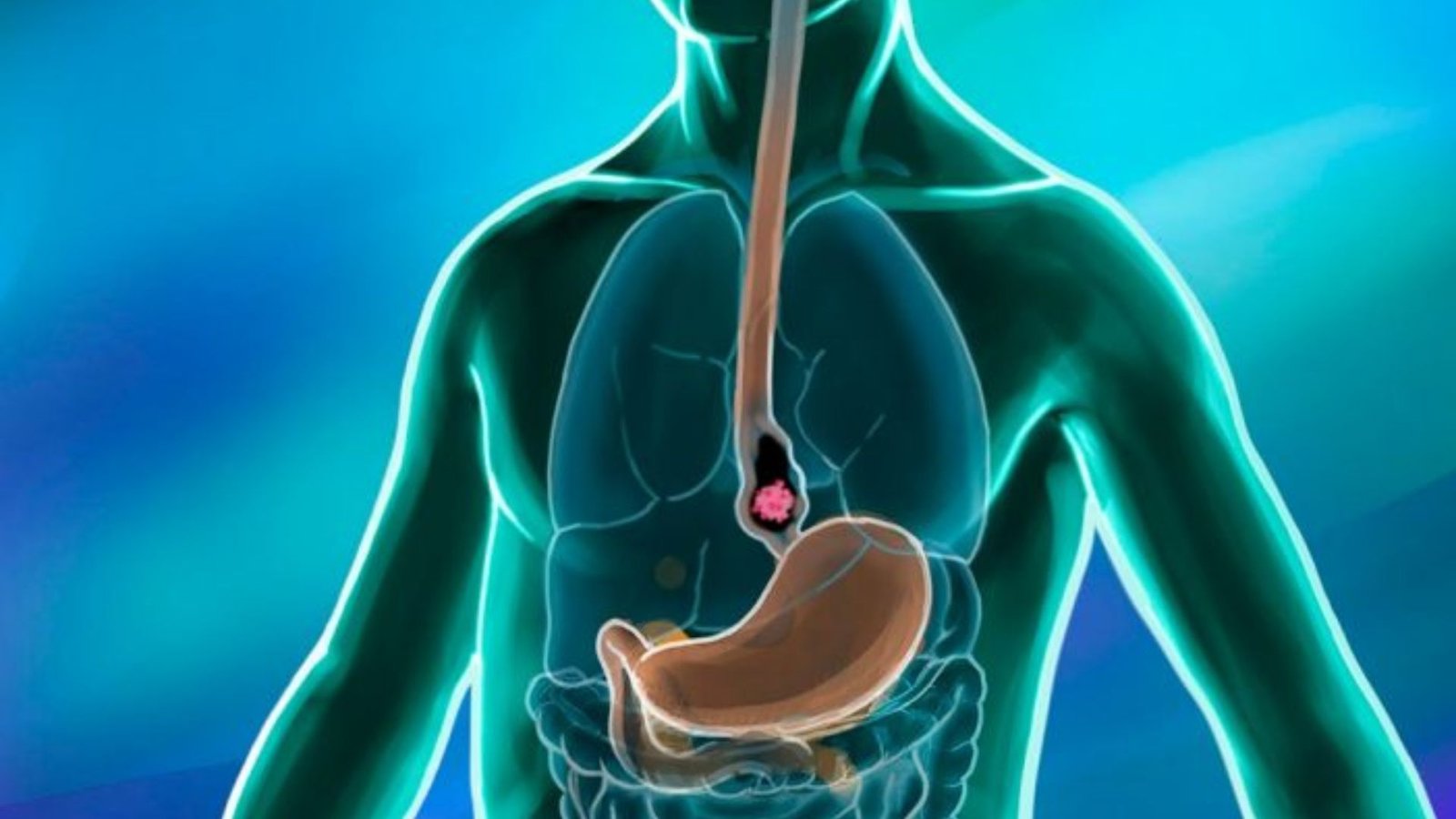 How to Choose the Best Treatment Center for Esophageal Cancer Key Factors to Consider