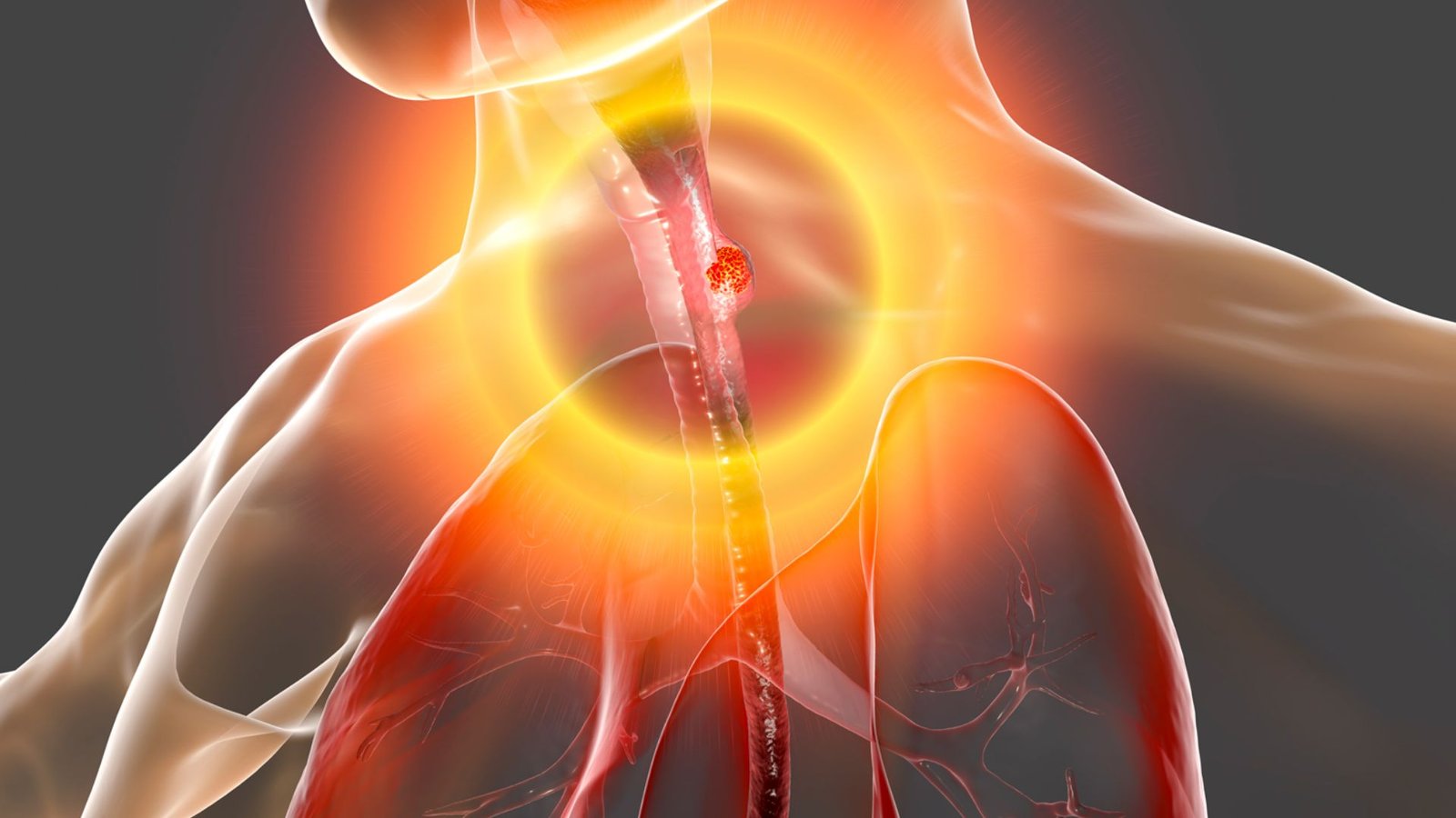 How to Choose the Best Treatment Center for Esophageal Cancer: Key Factors to Consider