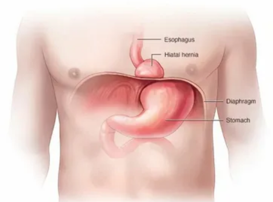 Hiatal Hernia surgeons in Dubai