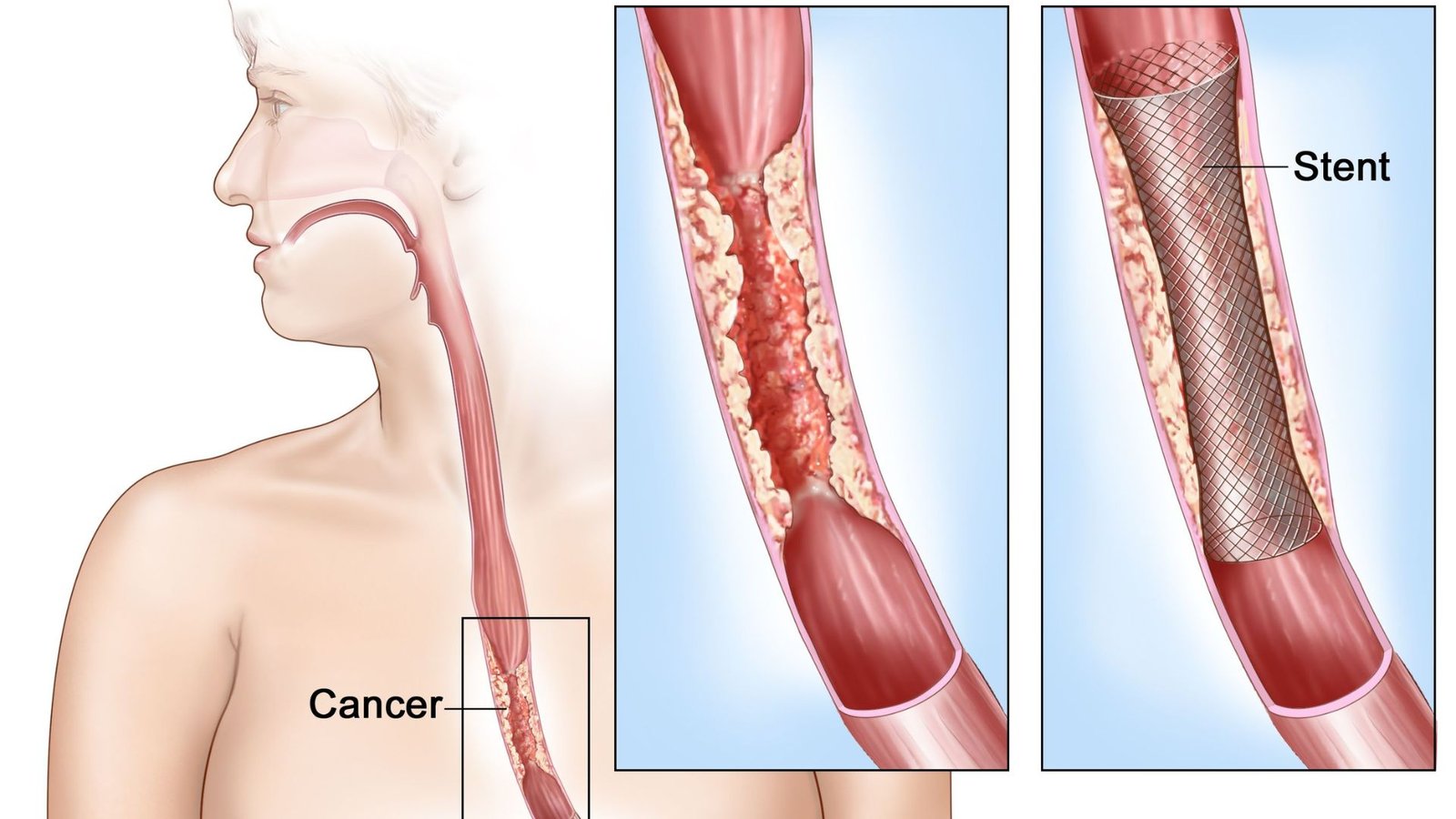 Esophageal Surgery