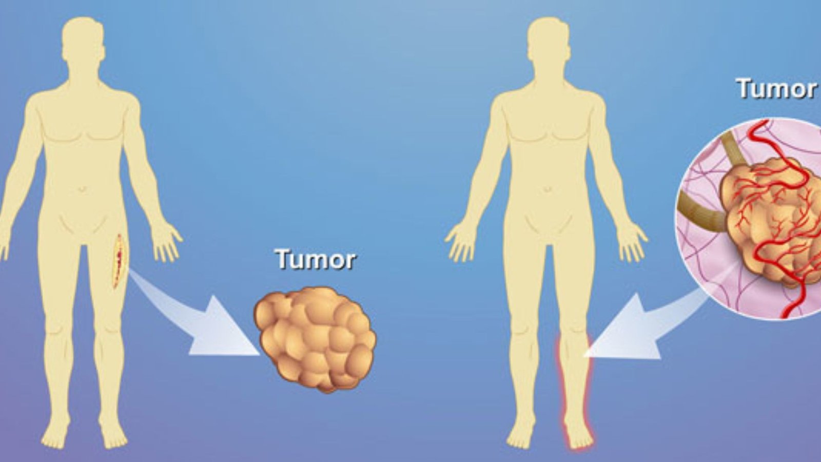 sarcoma surgery 