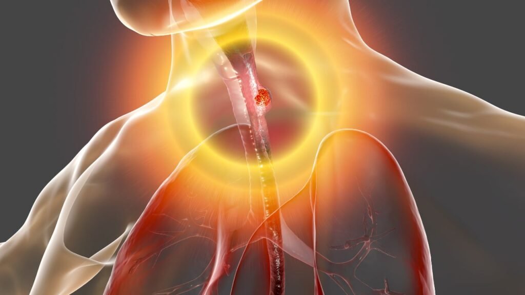 Esophageal Cancer