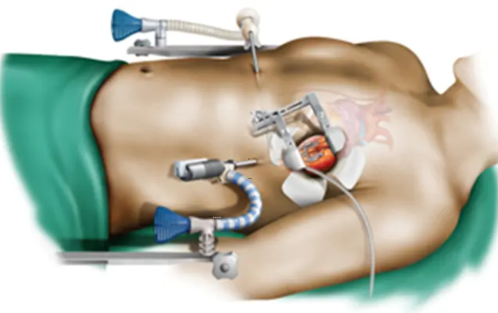 When Is Minimally Invasive Cardiac Surgery the Right Choice?