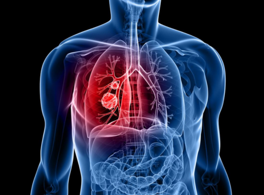 Lung Cancer Treatment Doctors in Dubai