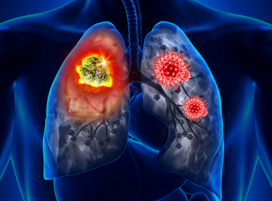 Lung Cancer surgery in Dubai