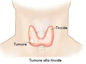 Thyroid Cancer