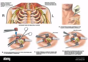 Thoracic Surgery