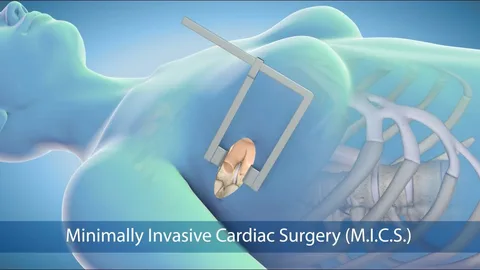 Where Can You Get Minimally Invasive Cardiac Surgery? Top Hospitals & Clinics.