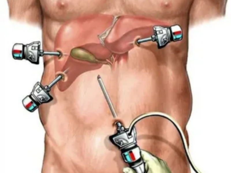 laparoscopic techniques